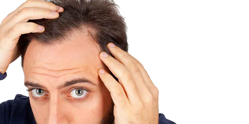 Key Points of Successful Hair Transplantation