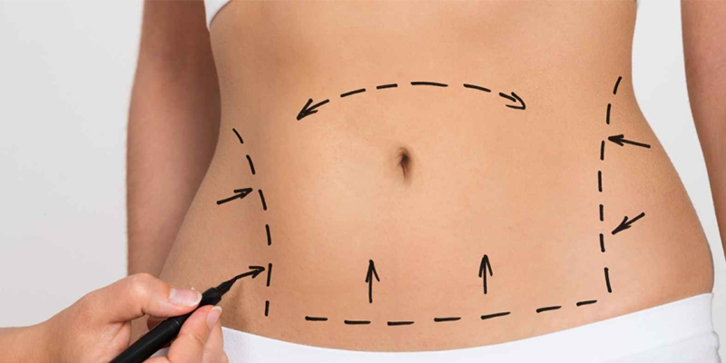 Abdominoplasty (Tummy Tuck) Surgery